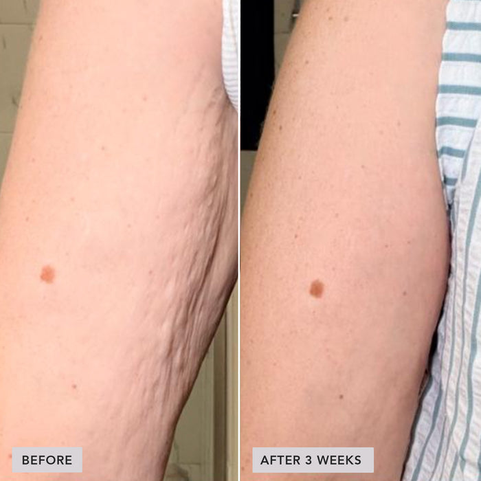 A side-by-side before and after comparison of a person's upper arm, showing stretch marks and skin texture improvement after 3 weeks. The left panel is labeled 'BEFORE' and the right panel 'AFTER 3 WEEKS'.