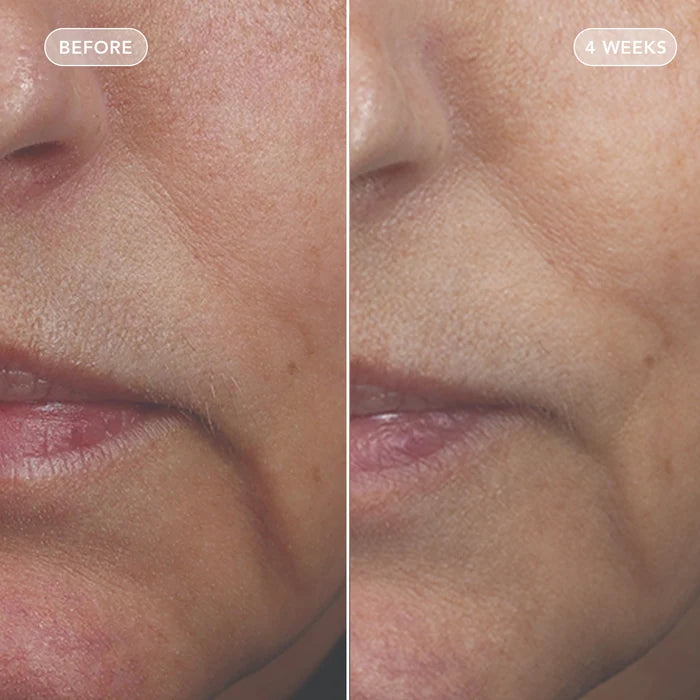 Close-up before-and-after comparison of a person's lower face, showing skin improvement over time with 'BEFORE' on the left and '4 WEEKS' on the right.